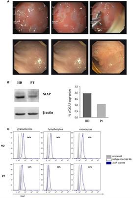 Novel X-Linked Inhibitor of Apoptosis Mutation in Very Early-Onset Inflammatory Bowel Disease Child Successfully Treated with HLA-Haploidentical Hemapoietic Stem Cells Transplant after Removal of αβ+ T and B Cells